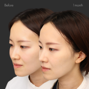 鼻翼縮小（内側）