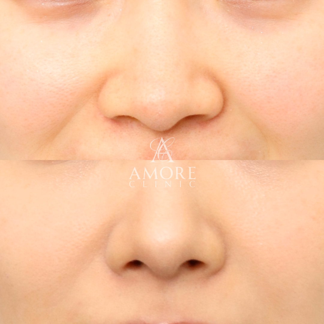 鼻翼縮小（内側）