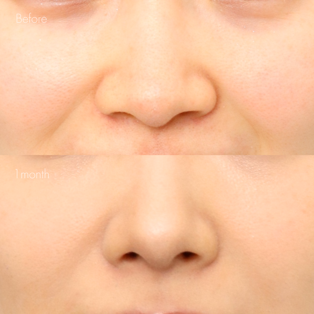 鼻翼縮小（内側）