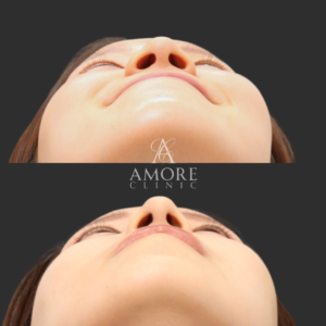 鼻翼縮小（内側）