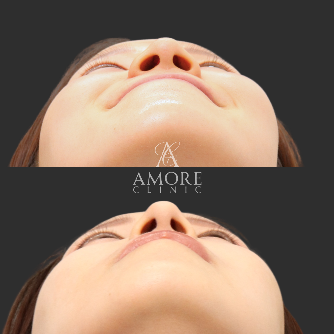 鼻翼縮小（内側）