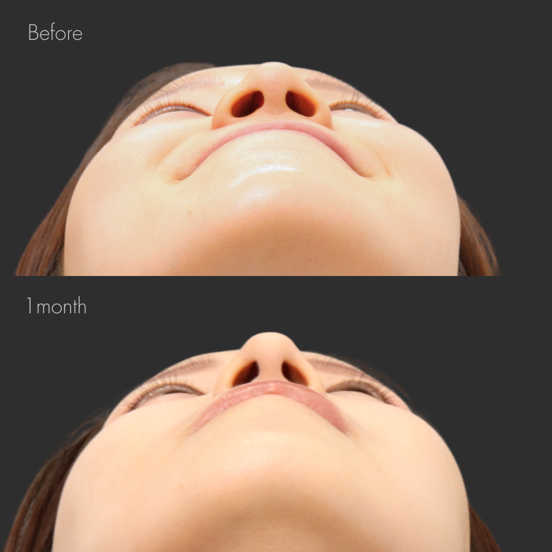 鼻翼縮小（内側）