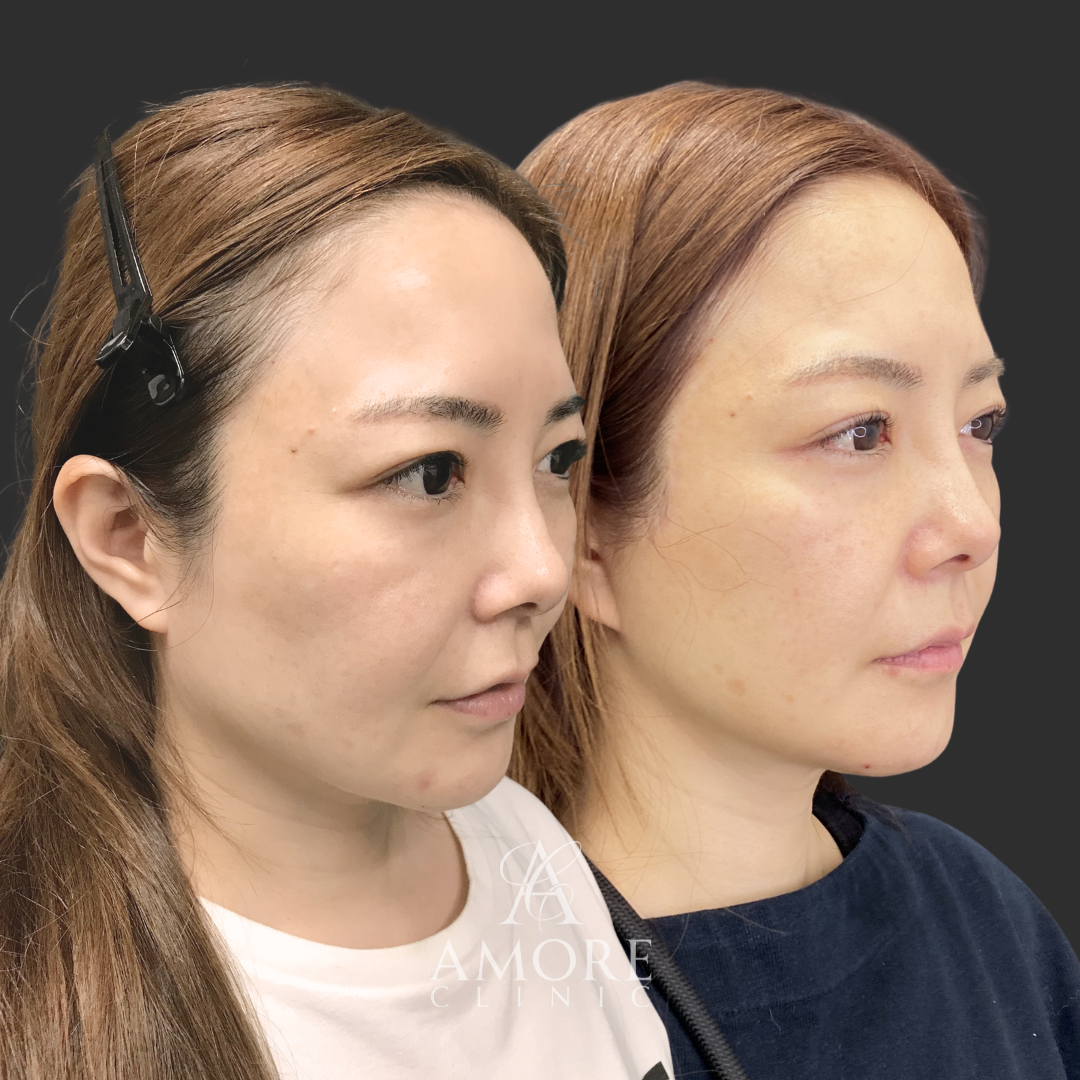 フルフェイスリフト