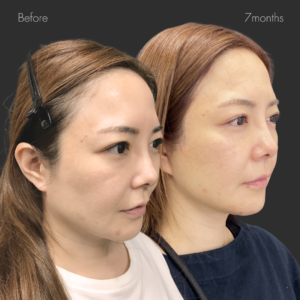 フルフェイスリフト