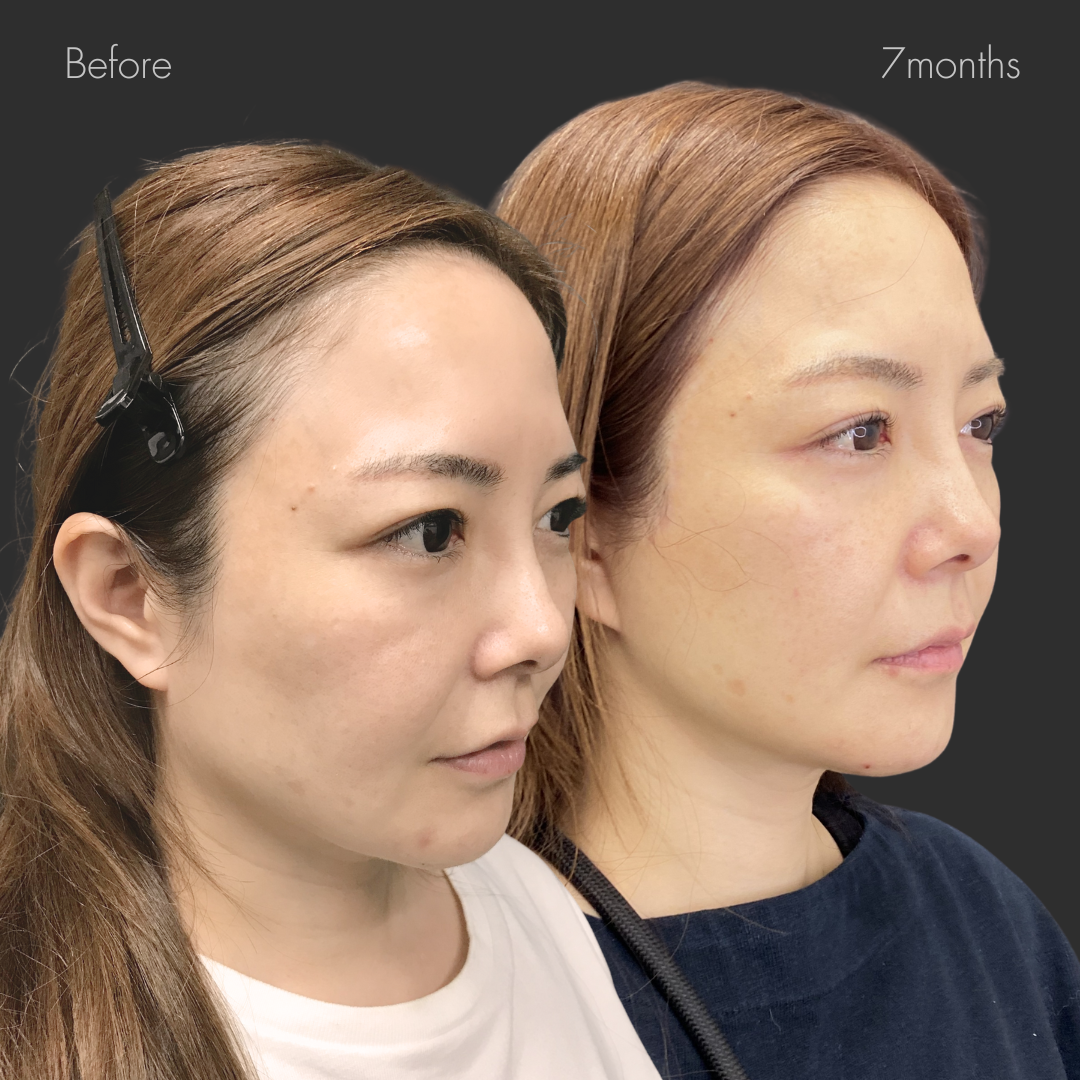 フルフェイスリフト