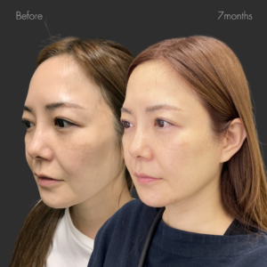 フルフェイスリフト