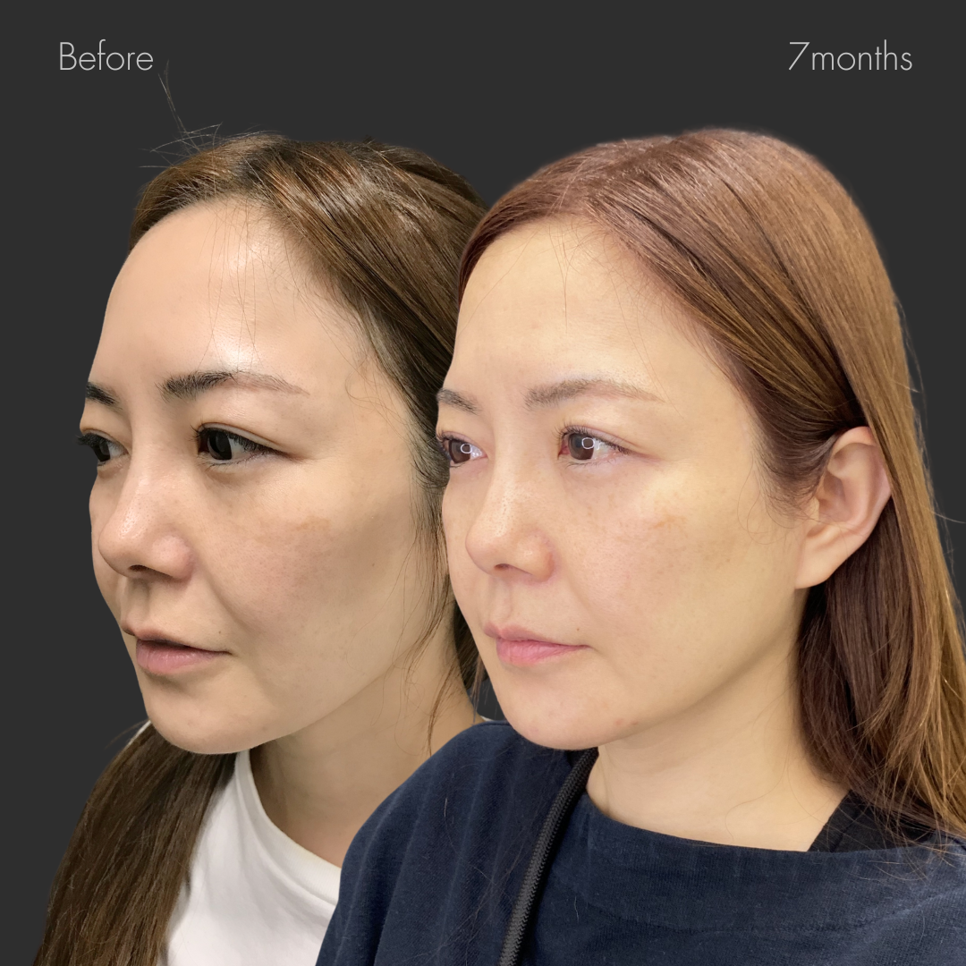 フルフェイスリフト