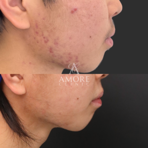 イソトレチノイン20mg