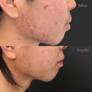 イソトレチノイン20mg