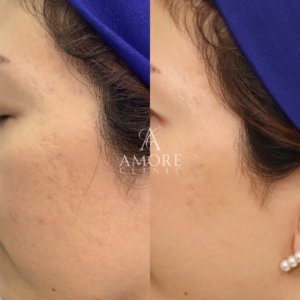 サブシジョン（両ほほ・こめかみ）