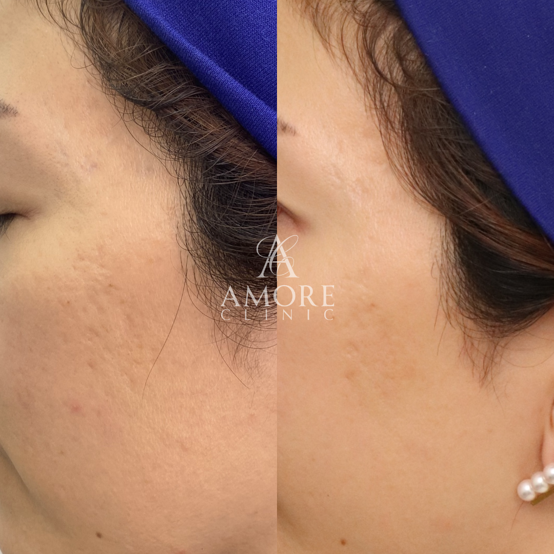 サブシジョン（両ほほ・こめかみ）