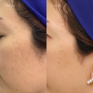 サブシジョン（両ほほ・こめかみ）