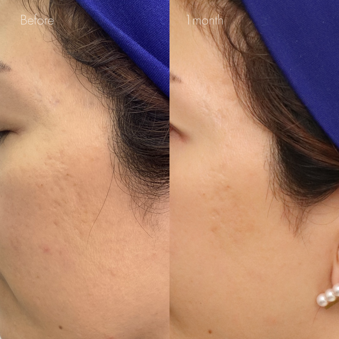 サブシジョン（両ほほ・こめかみ）