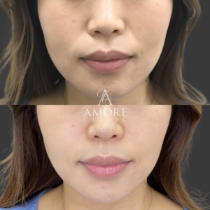 ほうれい線ヒアルロン酸（ジュビダームボリューマ1cc）