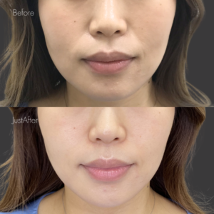 ほうれい線ヒアルロン酸（ジュビダームボリューマ1cc）