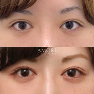 パーフェクト二重術（二重全切開＋たるみ除去＋脂肪除去）＋目頭切開＋グラマラスライン形成