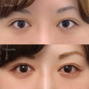 パーフェクト二重術（二重全切開＋たるみ除去＋脂肪除去）＋目頭切開＋グラマラスライン形成