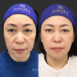 ミディアムリフト＋下眼瞼脱脂・たるみ除去