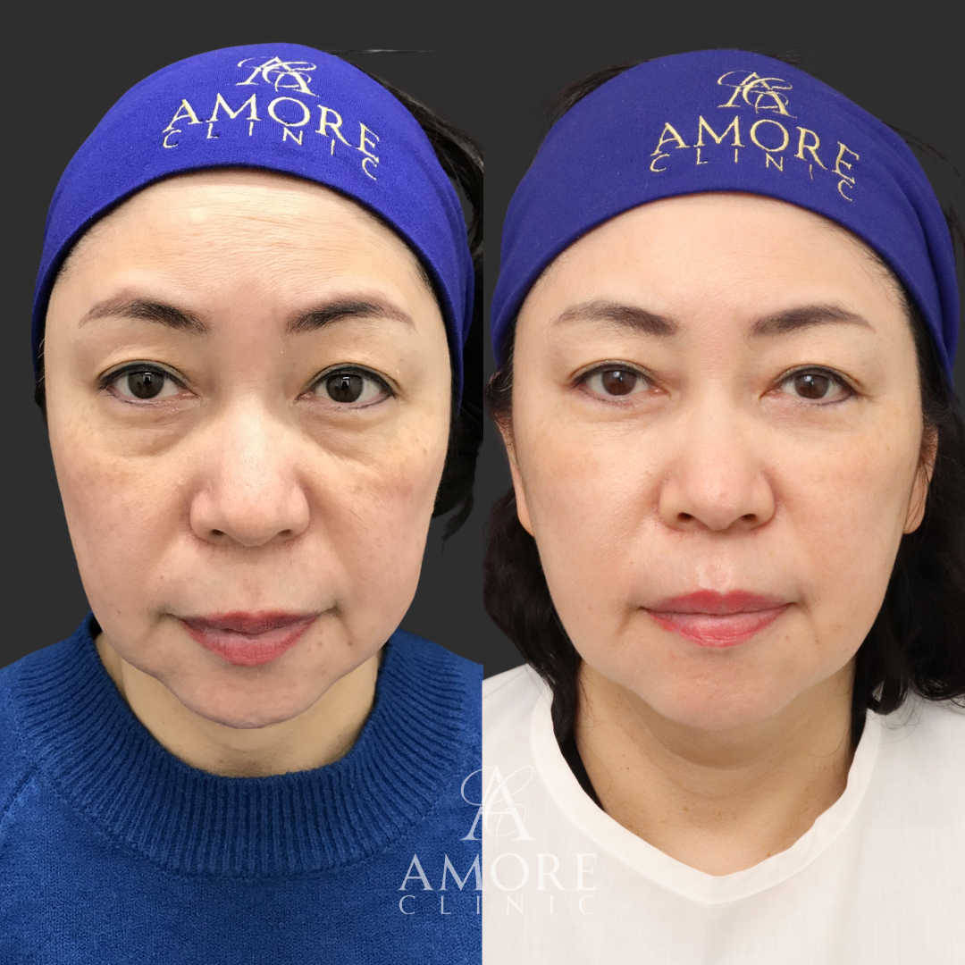 ミディアムリフト＋下眼瞼脱脂・たるみ除去