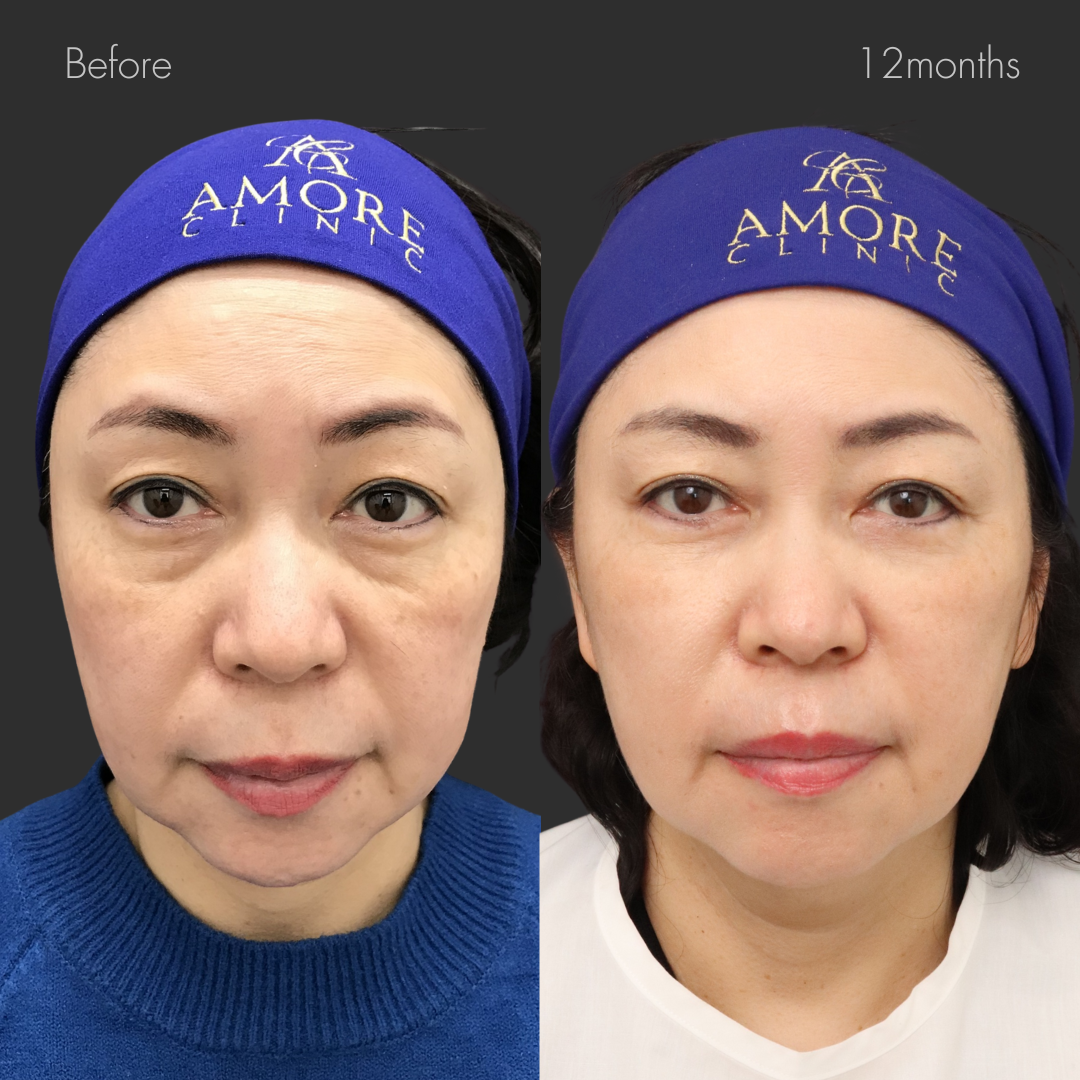 ミディアムリフト＋下眼瞼脱脂・たるみ除去