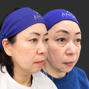 ミディアムリフト＋下眼瞼脱脂・たるみ除去