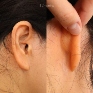 ミディアムリフト＋下眼瞼脱脂・たるみ除去