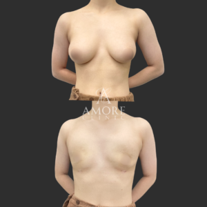  乳腺除去+乳房脂肪除去