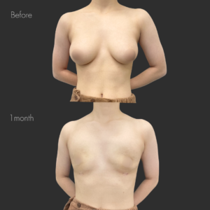  乳腺除去+乳房脂肪除去