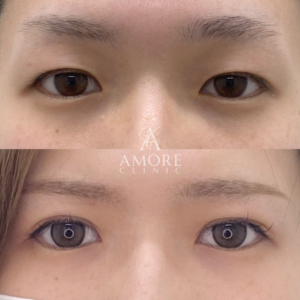 パーフェクト二重術（二重全切開＋たるみ除去＋脂肪除去）＋目頭切開＋目尻切開＋埋没糸抜去