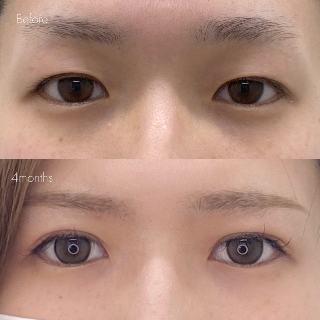 パーフェクト二重術（二重全切開＋たるみ除去＋脂肪除去）＋目頭切開＋目尻切開＋埋没糸抜去