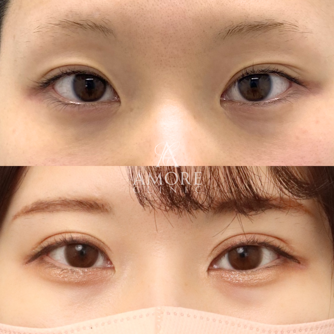 パーフェクト二重術（二重全切開＋たるみ除去＋脂肪除去）＋目頭切開＋埋没糸抜去