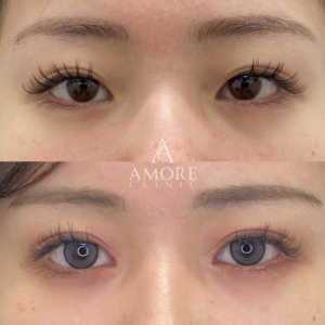 パーフェクト二重術（二重全切開＋たるみ除去＋脂肪除去）＋目頭切開＋埋没糸抜去