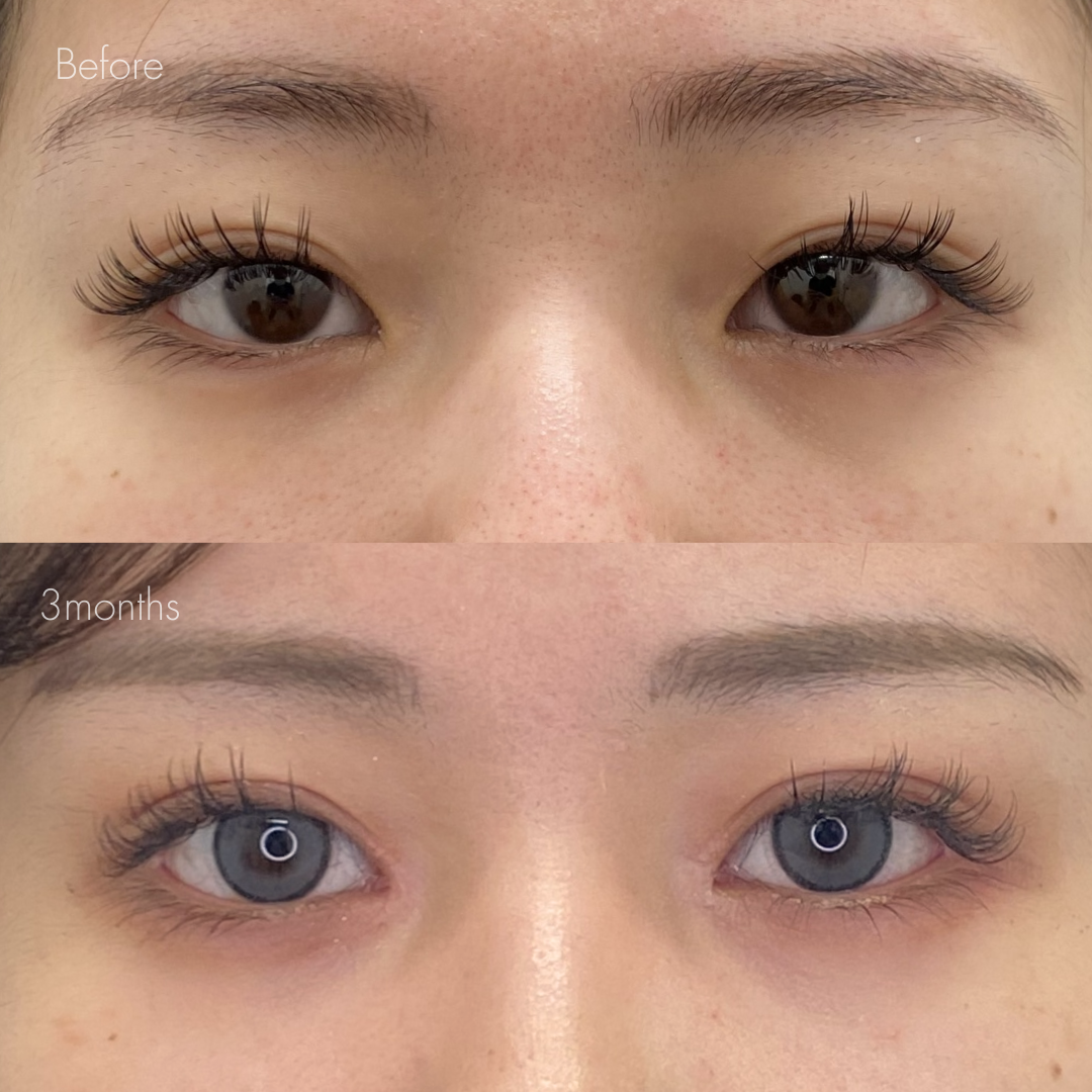 パーフェクト二重術（二重全切開＋たるみ除去＋脂肪除去）＋目頭切開＋埋没糸抜去