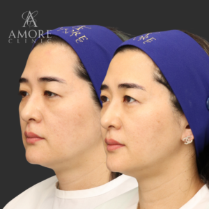 オーダーメイドヒアルリフト（ジュビダーム3㏄）