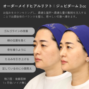 オーダーメイドヒアルリフト（ジュビダーム3㏄）