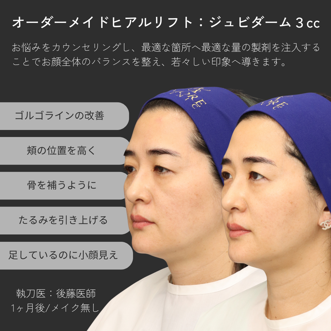 オーダーメイドヒアルリフト（ジュビダーム3㏄）