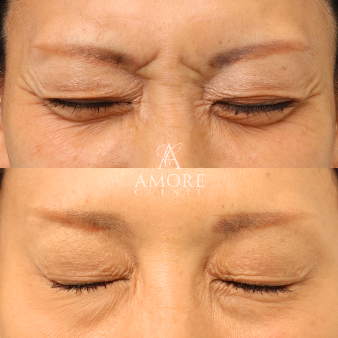 眉間ボトックス