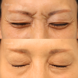 眉間ボトックス