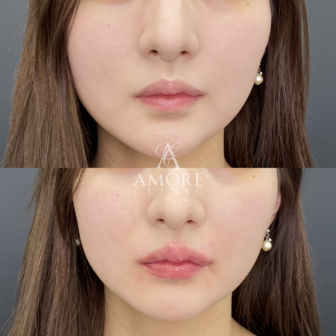 M字リップセット（唇ヒアルロン酸＋口角ボトックス）