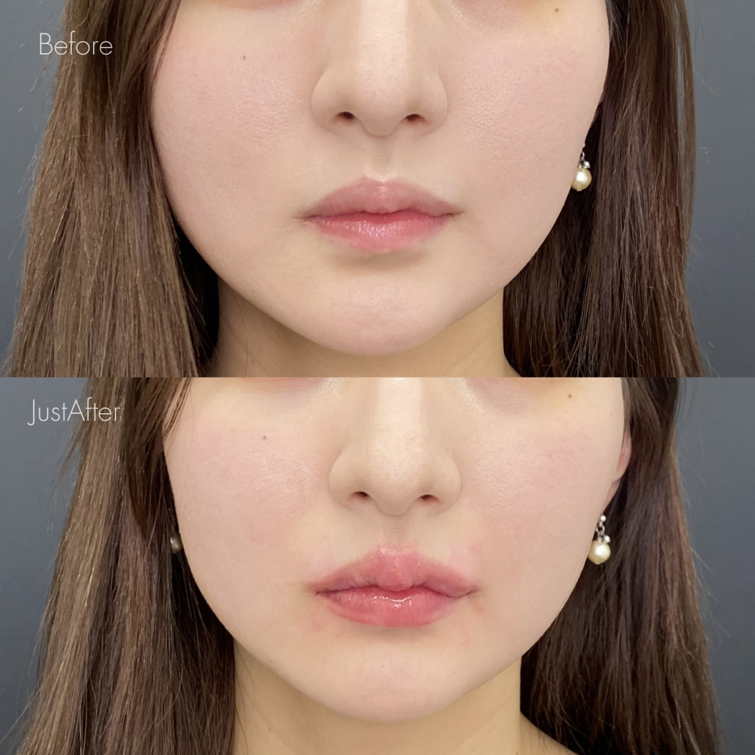 M字リップセット（唇ヒアルロン酸＋口角ボトックス）