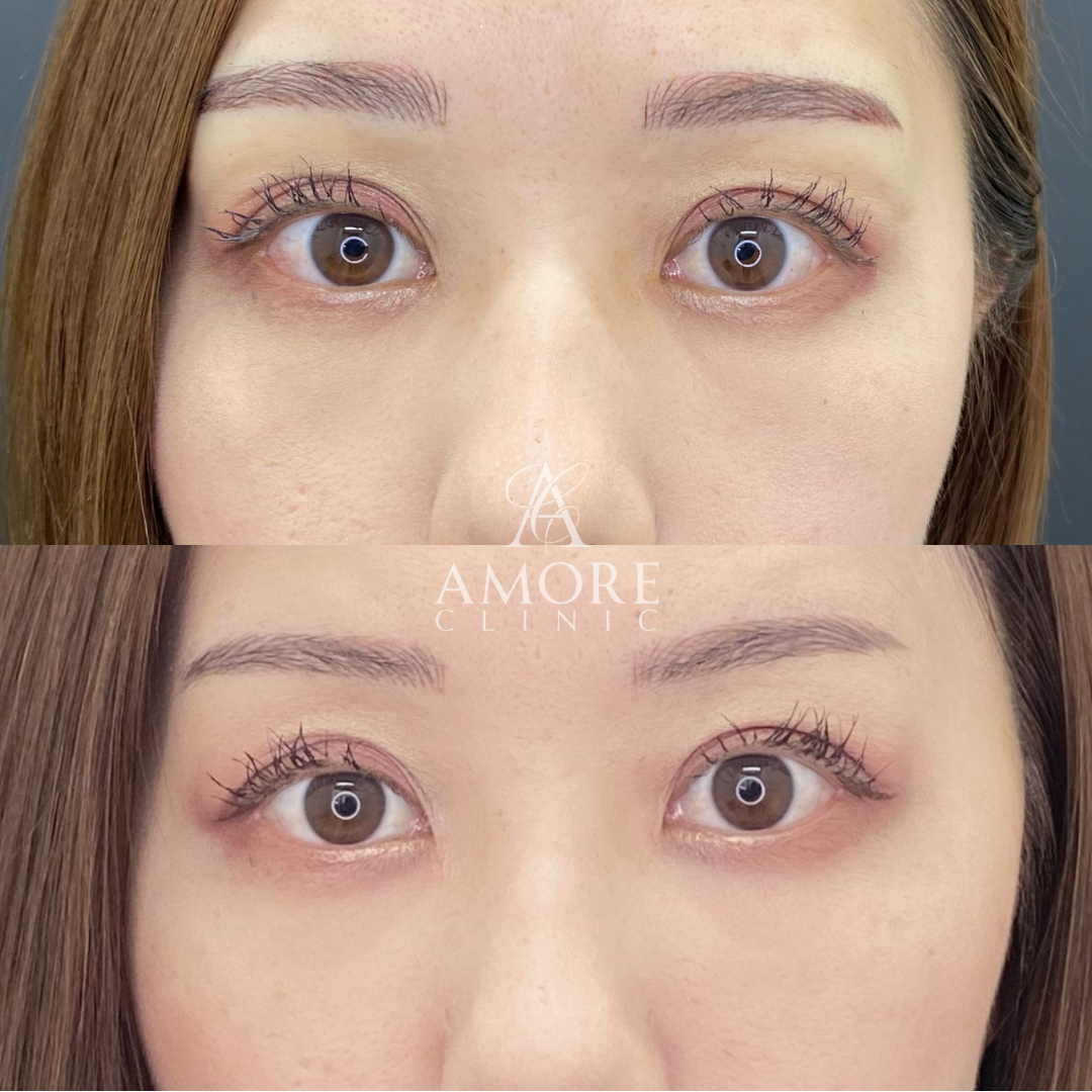 ゴルゴラインヒアルロン酸（ジュビダーム2cc）