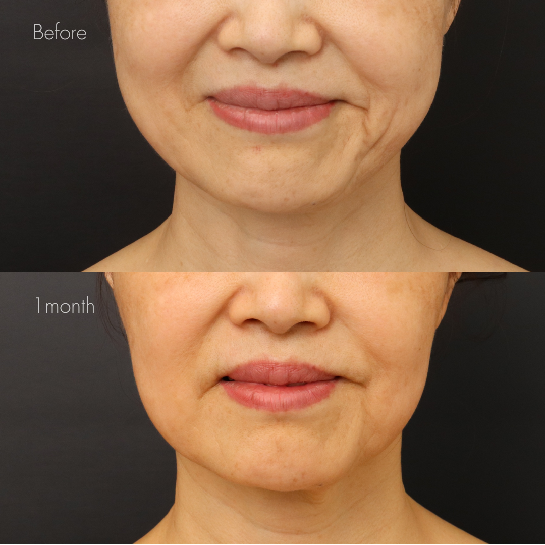 エラボトックス・ボツリヌストキシン注射