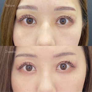 ゴルゴラインヒアルロン酸（ジュビダーム2cc）