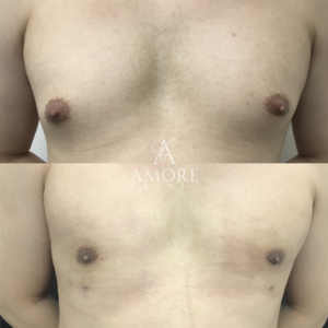 女性化乳房（乳腺・乳房脂肪除去）