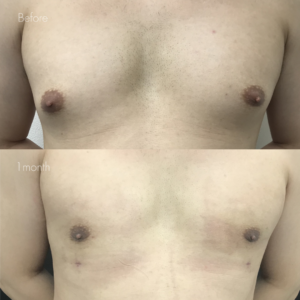 女性化乳房（乳腺・乳房脂肪除去）