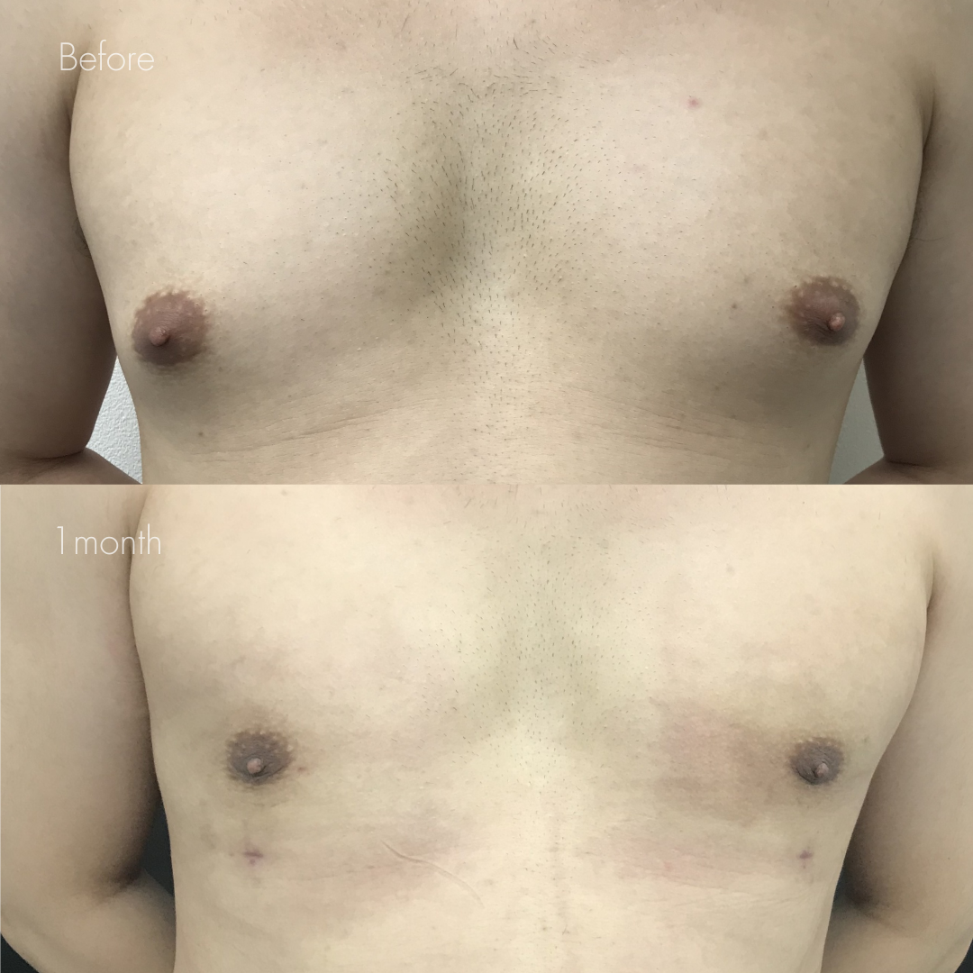 女性化乳房（乳腺・乳房脂肪除去）