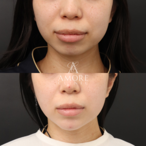 アゴ出しスレッド