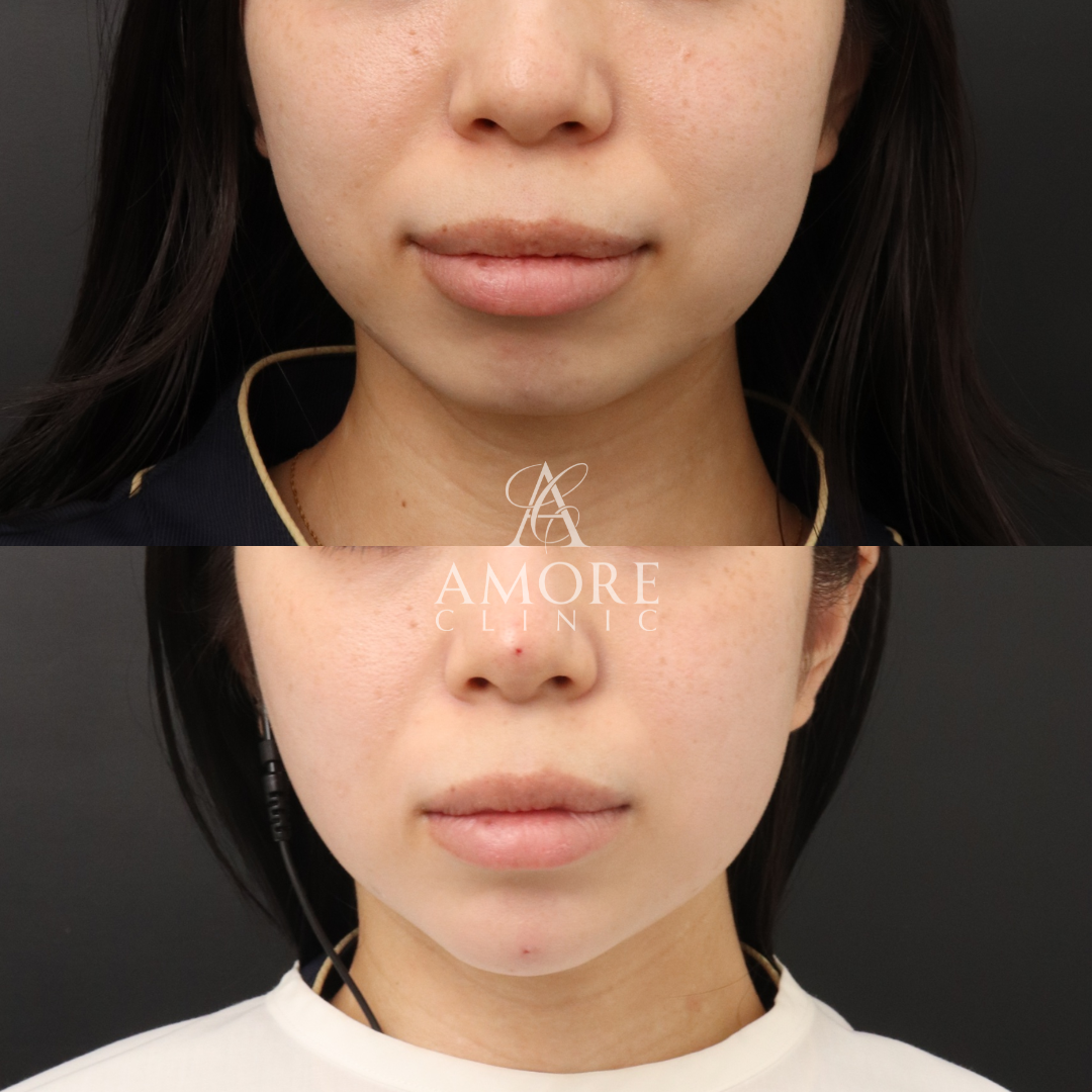 アゴ出しスレッド