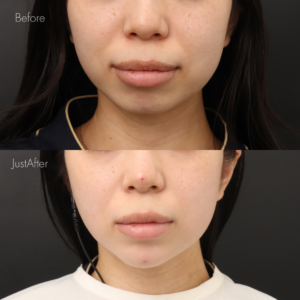 アゴ出しスレッド