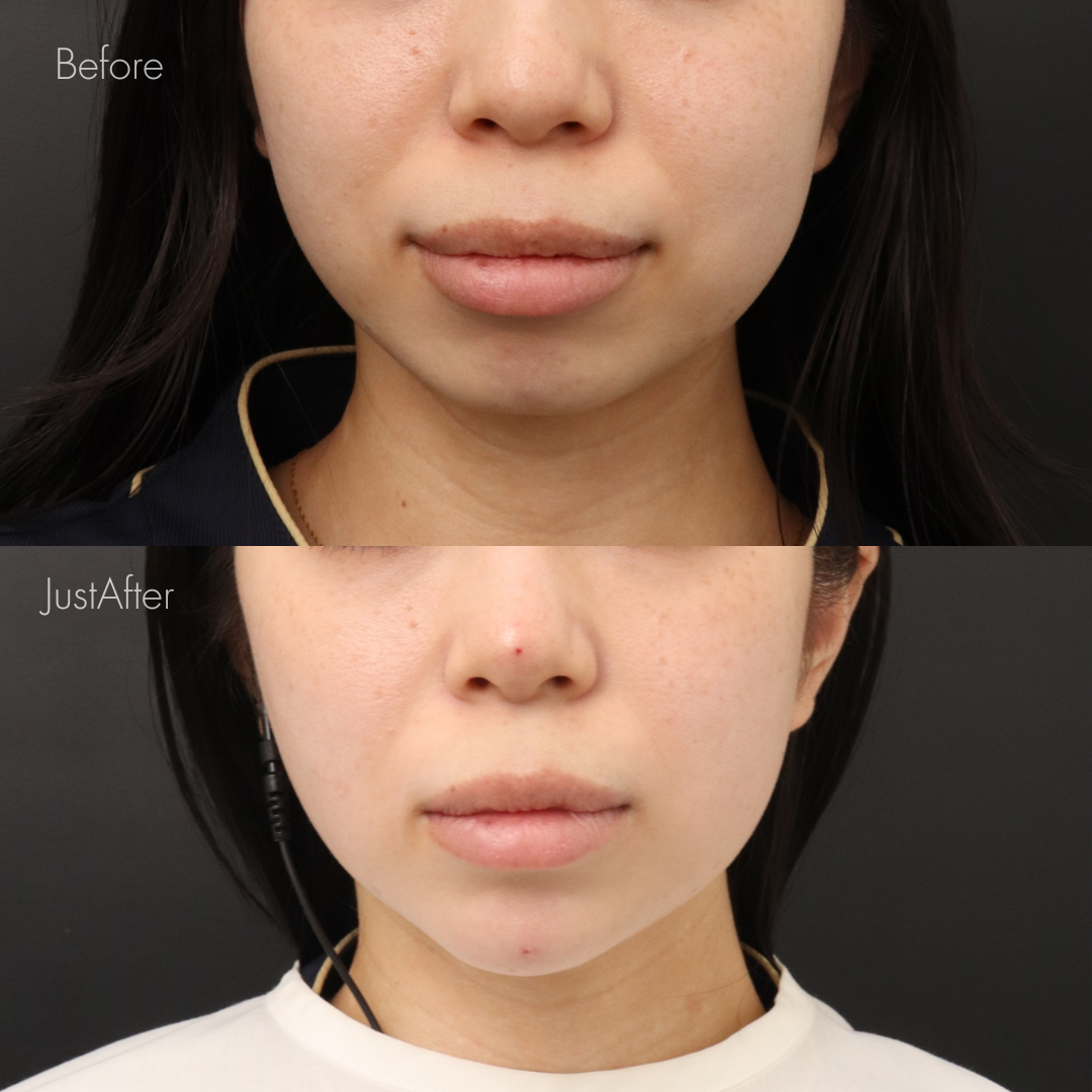 アゴ出しスレッド